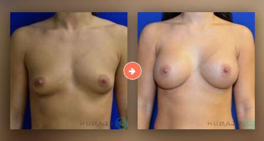 Breast Augmentation Before and After Pictures Augusta, GA