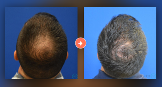 Follicular Unit Extraction (FUE) Before and After Pictures Augusta, GA