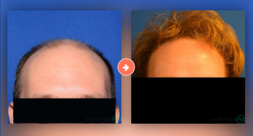 Hair Transplant Before and After Pictures Augusta, GA