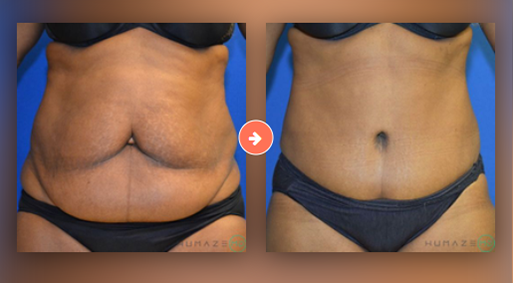 Liposuction Before and After Pictures Augusta, GA