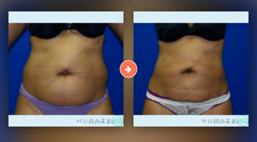 Liposuction Before and After Pictures Augusta, GA