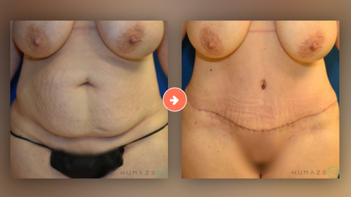 Tummy Tuck Before and After Pictures Augusta, GA