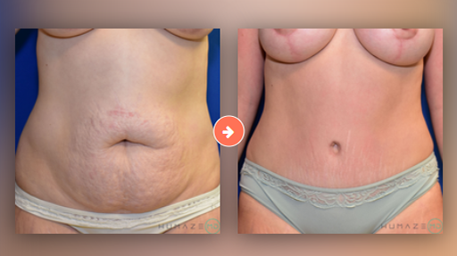 Tummy Tuck Before and After Pictures Augusta, GA