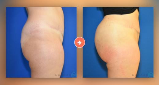 Brazilian Butt Lift Before and After Pictures Augusta, GA