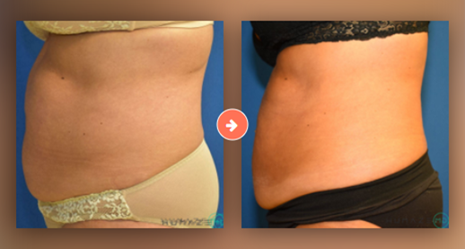 CoolSculpting® & CoolSculpting Elite Before and After Pictures Augusta, GA