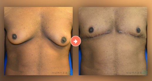 Gynecomastia Surgery Before and After Pictures Augusta, GA