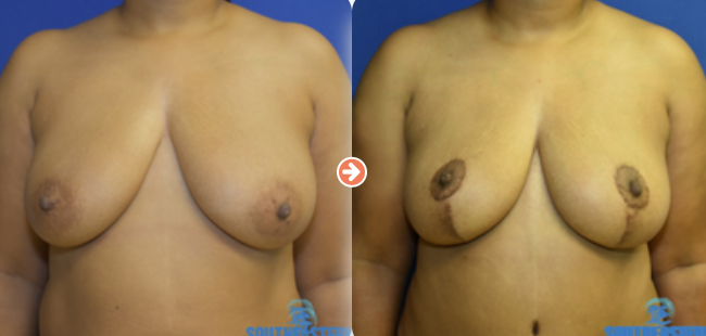 Breast Lift Before and After Pictures Augusta, GA