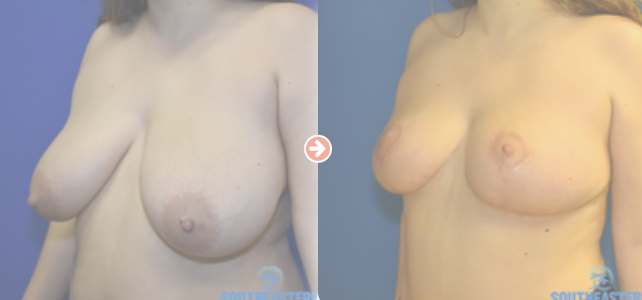 Breast Lift Before and After Pictures Augusta, GA