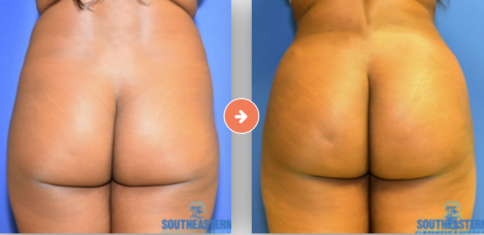 Brazilian Butt Lift Before and After Pictures Augusta, GA