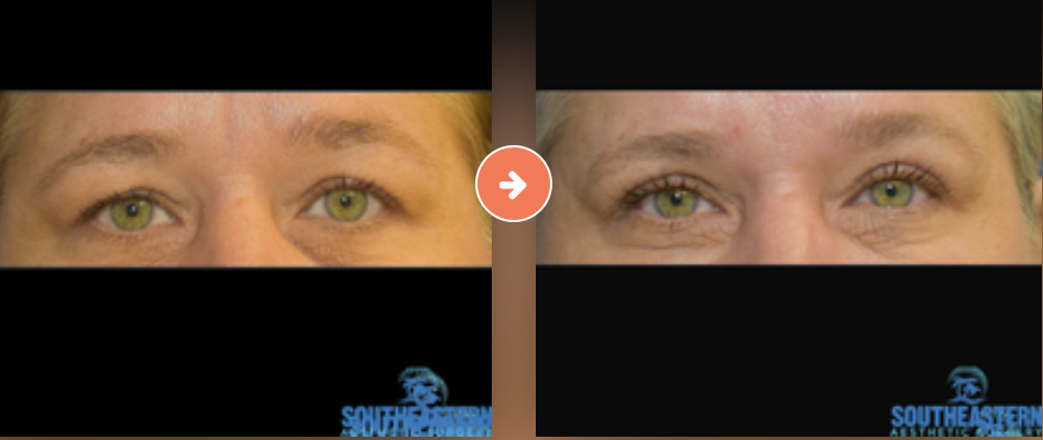Facelift Before and After Pictures Augusta, GA