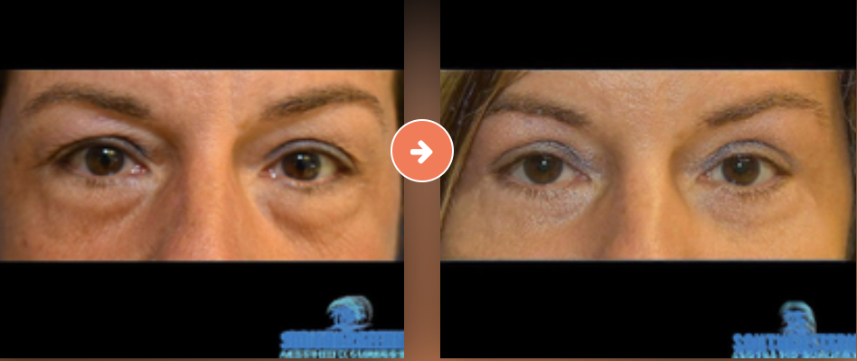 Blepharoplasty Before and After Pictures Augusta, GA
