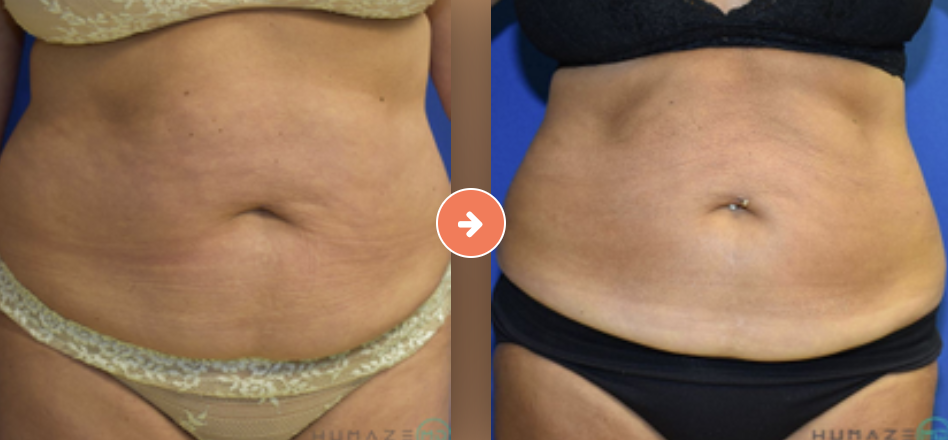 CoolSculpting Before and After Pictures Augusta, GA