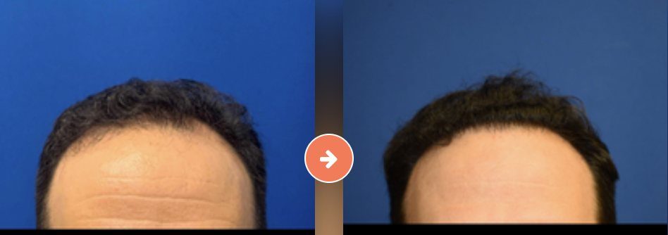 Hair Restoration for Men Before and After Pictures Augusta, GA