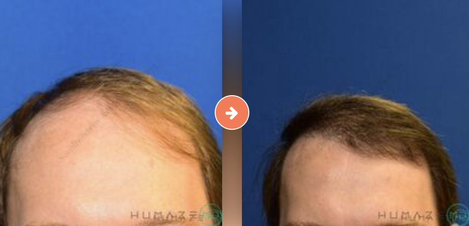 Hair Restoration for Men Before and After Pictures Augusta, GA