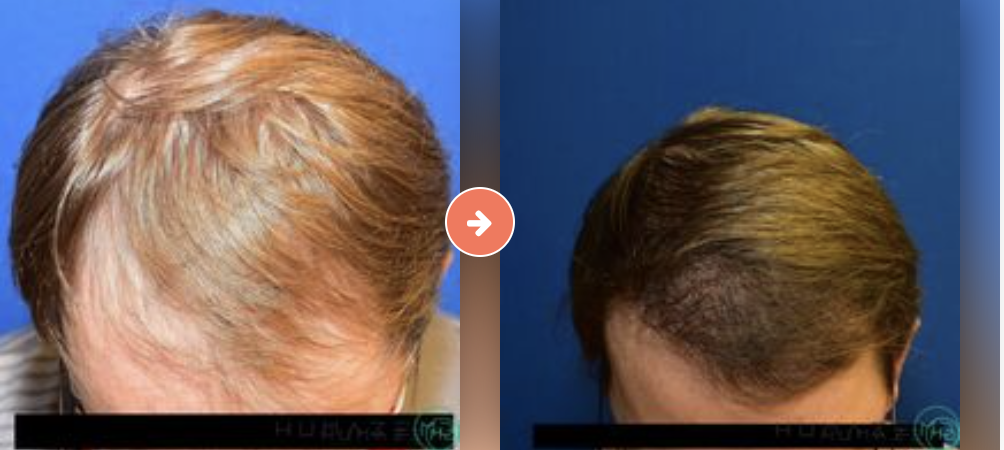 Hair Transplant Before and After Pictures Augusta, GA
