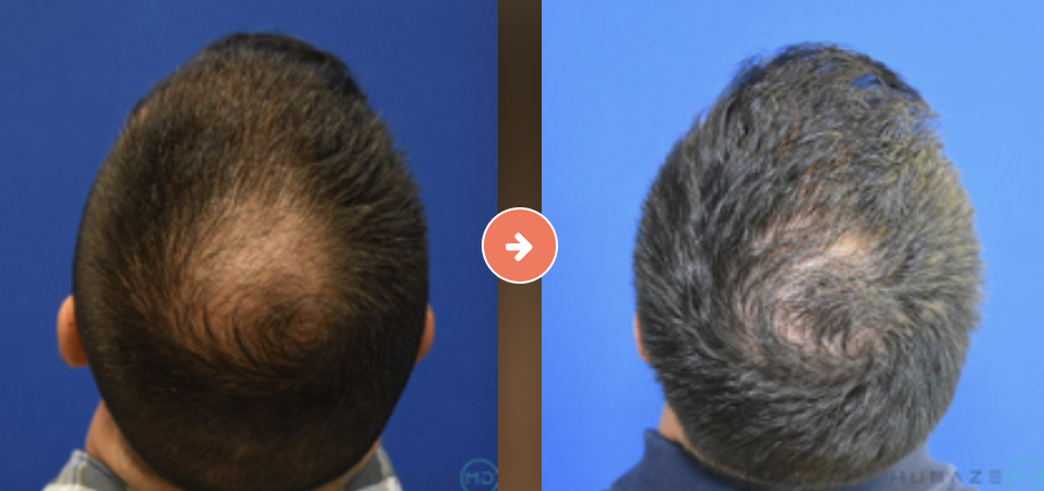 NeoGraft Hair Transplantation Before and After Pictures Augusta, GA