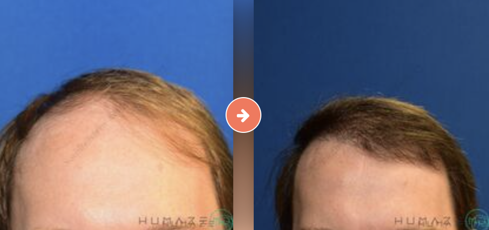 NeoGraft Hair Transplantation Before and After Pictures Augusta, GA