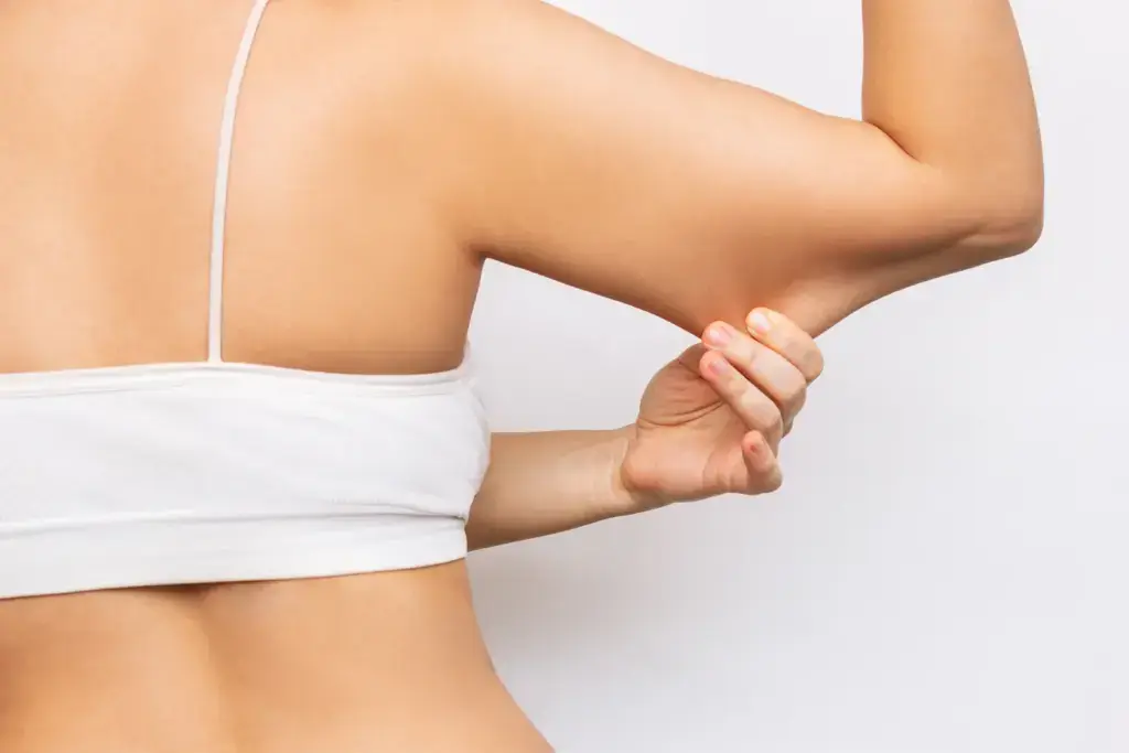 Woman pinching loose upper arm skin, one of the most common BodyTite treatment areas in Augusta, GA